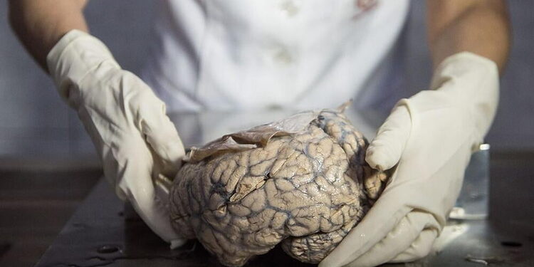 Doctor Diana Rivas displays a human brain on a working surface at the "Museum of Neuropathology" in Lima on November 16, 2016.
The "Museum of Neuropathology" at the Santo Toribio de Mogrovejo hospital bears a collection of 290 brains and offers an unusual journey by encephalic masses unrevealing the secrets of the most complex organ of the human body. / AFP / ERNESTO BENAVIDES        (Photo credit should read ERNESTO BENAVIDES/AFP/Getty Images)